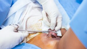 Especialista en ginecología haciendo la labioplastia funcional a paciente en Cali