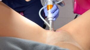 Video de Youtube breve sobre el tensado vaginal