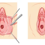How to Reduce the Size of the Labia Majora: Causes, Medical Options, and Intimate Wellness - Clinica Zenska