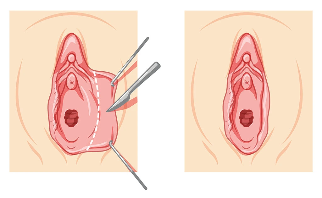 How to Reduce the Size of the Labia Majora: Causes, Medical Options, and Intimate Wellness - Clinica Zenska